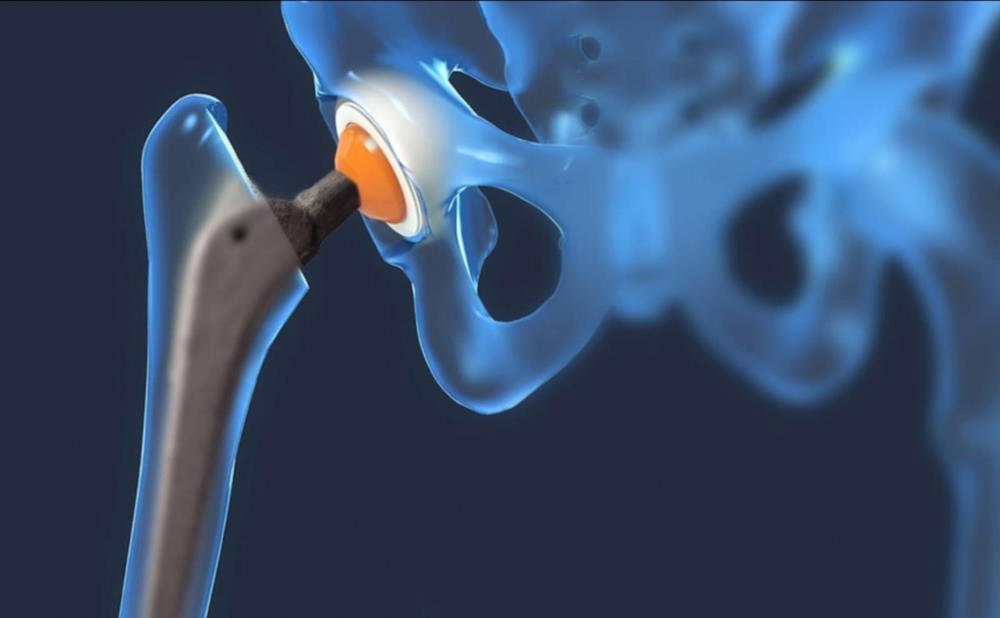 Пермские ученые разработали протез тазобедренного сустава из композиционного материала